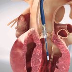 Stenosi della valvola aortica: i vantaggi della procedura TAVI
