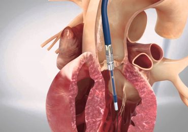 Stenosi della valvola aortica: i vantaggi della procedura TAVI