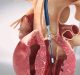 Stenosi della valvola aortica: i vantaggi della procedura TAVI