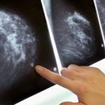 Tumore al seno, terapia a casa per due donne: prima volta in Italia