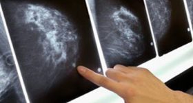 Tumore al seno, terapia a casa per due donne: prima volta in Italia