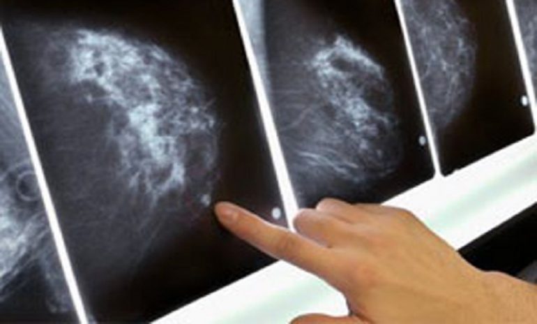 Tumore al seno, terapia a casa per due donne: prima volta in Italia