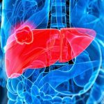 Carcinomi epatocellulari, scoperta la “firma molecolare” che li caratterizza.