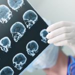 Epilessia, terapia anti-neuroinfiammatoria apre nuovi scenari.
