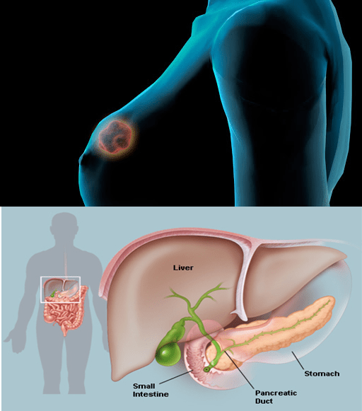 Nuovi farmaci oncologici:: Tucatinib e Olaparib