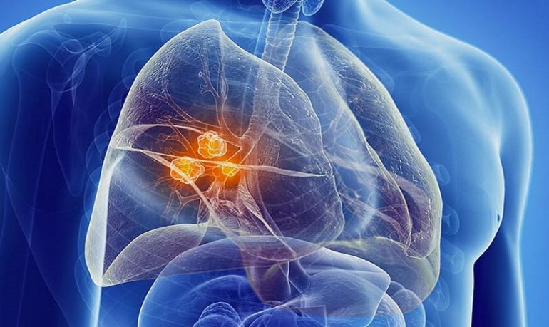 Studio Nelson conferma: lo screening del cancro al polmone salva la vita.