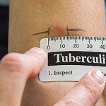 Tubercolosi: importanti progressi per vaccini e terapia farmacologica nel 2019.