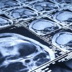 Ictus ischemico acuto: indispensabile la trombolisi endovenosa prima della trombectomia meccanica?