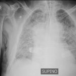 Ventilazione meccanica e polmonite da coronavirus