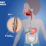 Nasce lo stent "dinamico" per curare le lesioni esofagee nel bambino