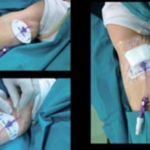 Tesi infermieristica. Picc: nuove prospettive per gli accessi vascolari