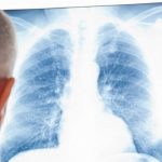 Coronavirus, il 30% dei guariti manifesta problemi polmonari cronici