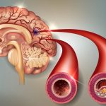 Ictus, Trombolisi, tempo somministrazione e  mortalità: un nuovo studio suggerisce tempistiche