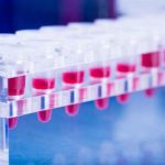 Leucemia mieloide acuta: caso di remissione completa con Venetoclax associato alla chemio