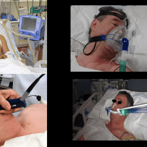 Nuove evidenze tra ventilazione non invasiva e intubazione orotracheale in caso di IRA: lo studio.