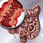 IG-IBD - Malattie infiammatorie croniche intestinali: nei pazienti con Crohn e Colite ulcerosa il rischio da contagio da Covid-19 non è aumentato 2