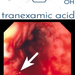 Adido tranexamico e sanguinamenti gastro-intestinali. Lo studio