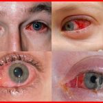 Estate e congiuntivite, quali rischi?