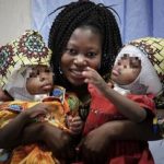 Gemelline siamesi con craniopagia totale separate per la prima volta in Italia