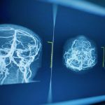 Ictus ischemico e TIA: combinazione ticagrelor-aspirina riduce recidive precoci