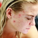 Quali cibi provocano l'acne?