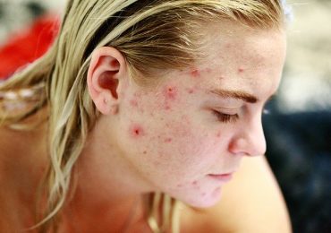 Quali cibi provocano l'acne?