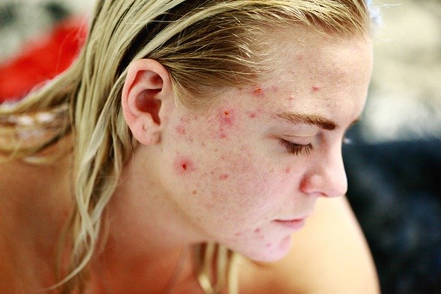 Quali cibi provocano l'acne?