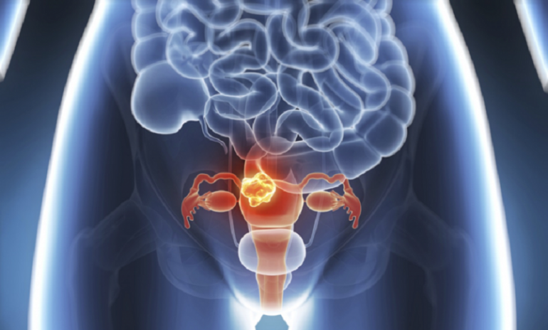 Tumore alla cervice uterina, parte dal "Gemelli" uno studio mondiale sull'immunoterapia