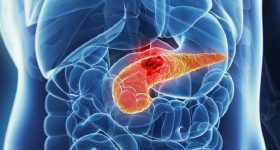 Tumore del pancreas: lo studio IEO sui benefici dell'immunoterapia