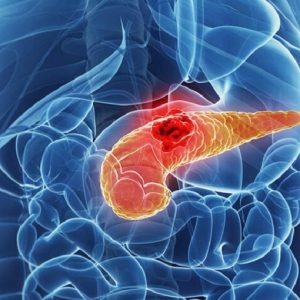 Tumore del pancreas: lo studio IEO sui benefici dell'immunoterapia