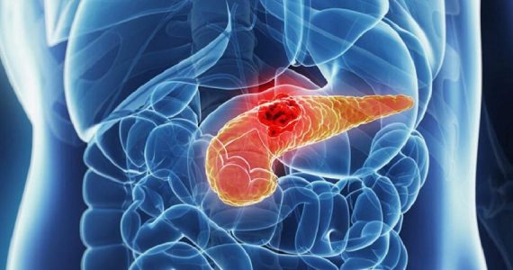 Tumore del pancreas: lo studio IEO sui benefici dell'immunoterapia