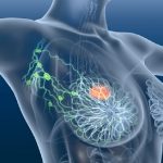 Cancro mammario, scoperto in antichi resti umani un virus che potrebbe causarlo