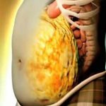 Coronavirus, grasso viscerale facilita tempesta citochinica