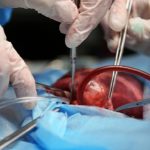 Delirio post-cardiochirurgia nei pazienti anziani: l'efficacia del paracetamolo