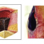 Infermieri e Wound Care. Scale Di classificazione/valutazione: stadiazione Npuap/Epuap 1