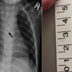 Usa, gancio nell'esofago le causa lesioni cerebrali e convulsioni: la disavventura di una piccola paziente