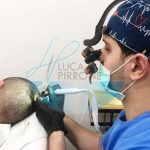 Trapianto di capelli: ruolo dell’infermiere come figura complementare.