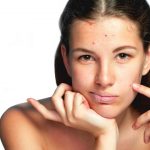 Acne, crema a base di clascoterone all’1% approvata dalla Fda