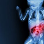 Enterocolite necrotizzante nel neonato