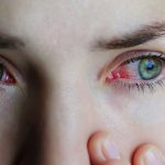 Glaucoma: le nuove armi nella terpia medica