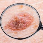 Melanoma in stadio avanzato: una combinazione di farmaci ritarda la progressione, ma in modo non significativo
