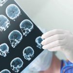 Micro-ictus, forse un primo passo verso la creazione di nuovi test clinici