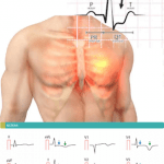 Nuove Linee Guida ESC 2020 per Trattamento IMA N-STEMI