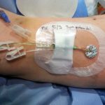 Studio sull'uso più restrittivo sul PICC line