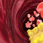 Terapia con statine: i benefici di Evolocumab