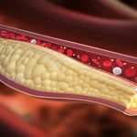 Coronavirus, statine dimezzano rischio di svilupparlo in forma grave