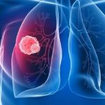 Mesotelioma, Fda approva la "doppietta" nivolumab-ipilimumab