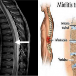 Mielite acuta trasversa. Cause, sintomi e terapia