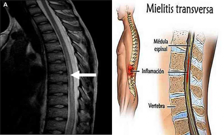 Mielite acuta trasversa. Cause, sintomi e terapia