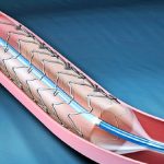 Nuovi stent a eluizione: sì a doppia terapia antipiastrinica più breve
